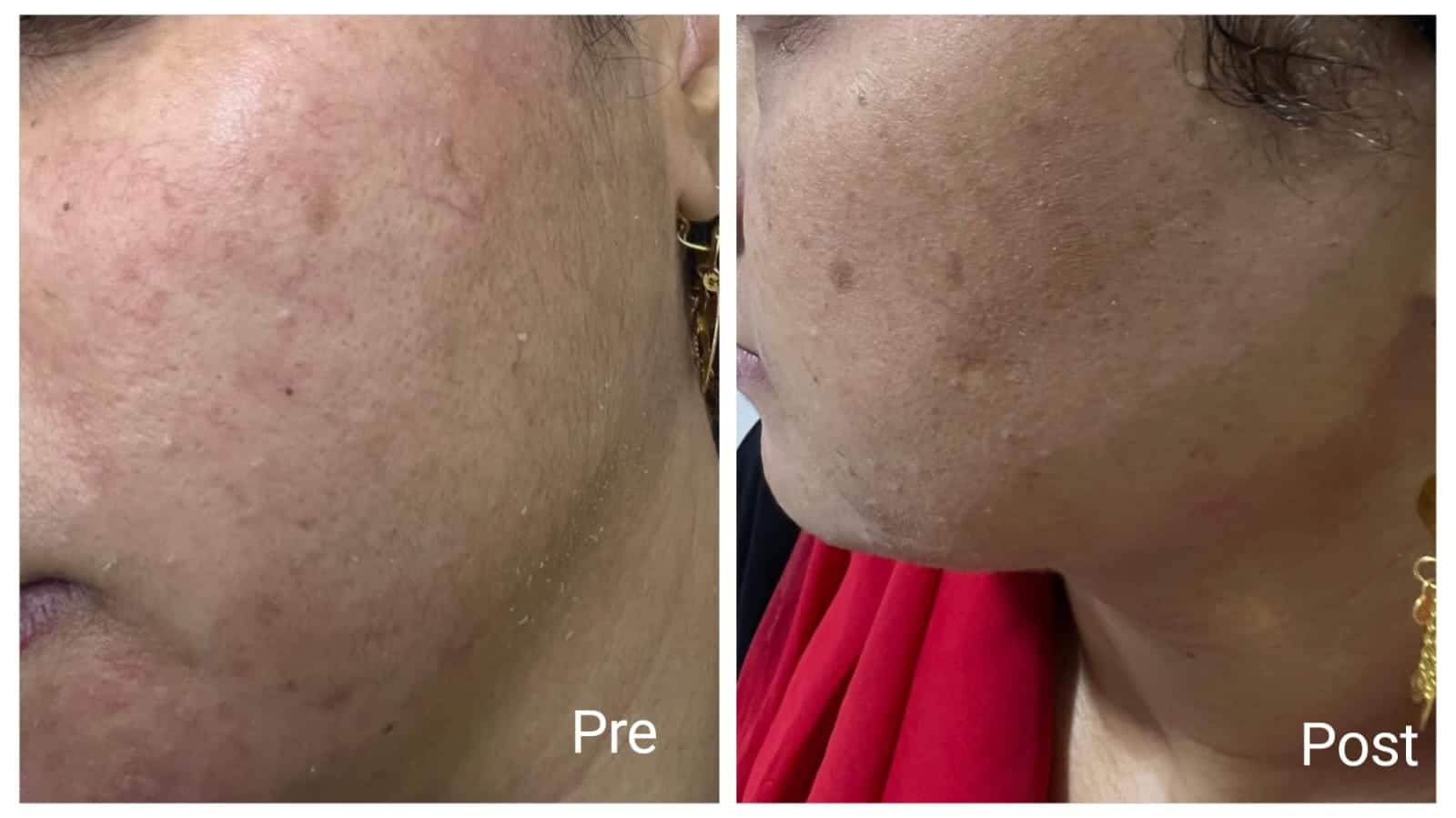 جلسات الميزوثيرابي والديرما بن في الغردقة مع أفضل أطباء طب الامراض الجلدية